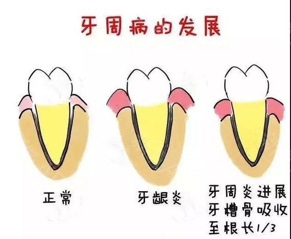 性急的人刷牙时既快又太用力,容易造成牙龈受力部分发生萎缩病变.