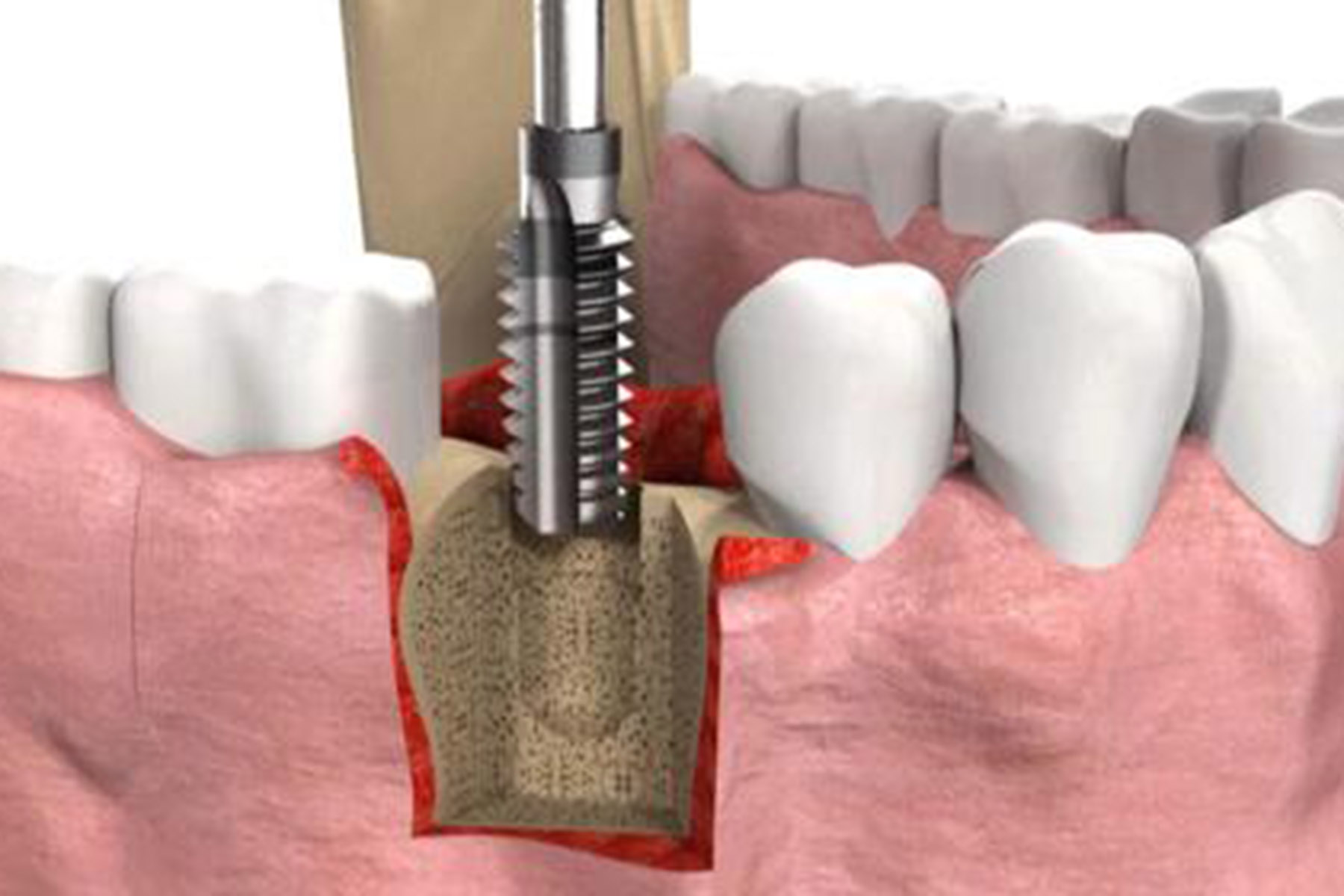 在发达国家,经种植牙手术的人10年存留率在90%左右,最长纪录为50年.